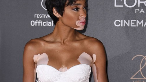 Winnie Harlow is bevadult a vörös szőnyegen