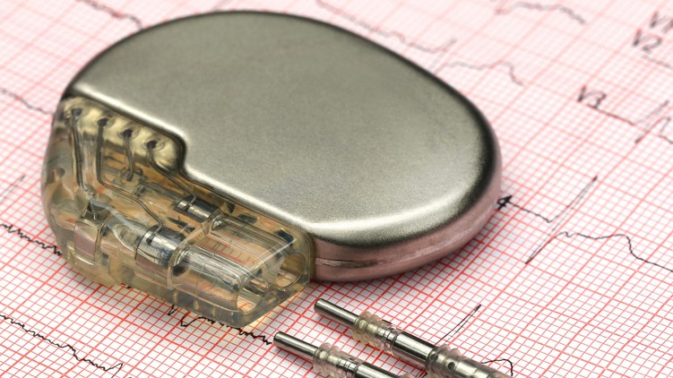 szívbetegség pacemaker, beültetés, után, orvos, tanács