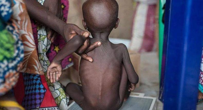 Children malnourished in the North