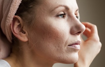 Pattanásos bőr felnőttkorban: ilyen kezelési lehetőségekben bízhat a szakértő szerint