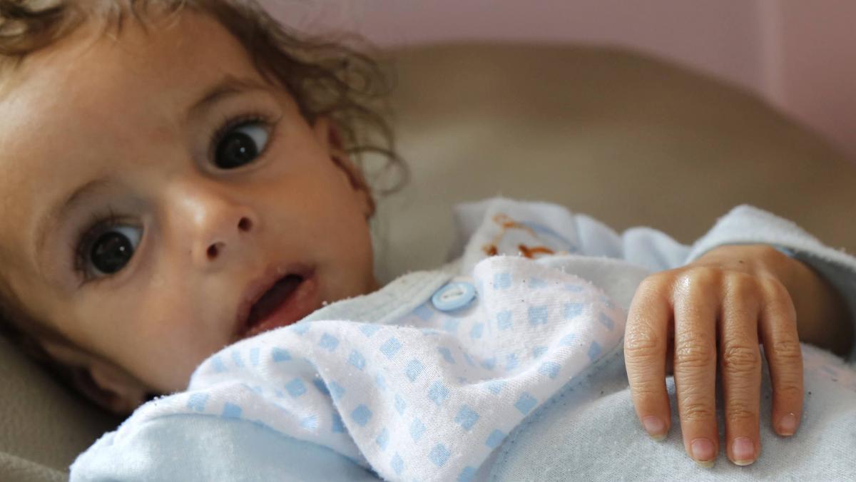 Ofiara głodu w Jemenie otrzymuje leczenie w szpitalu w Sanie, stolicy kraju