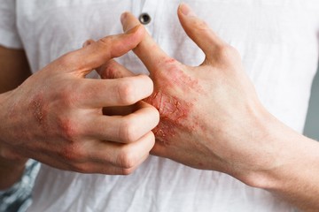 ekcéma, vakarózás, viszketés, fehérjék, sejt, kutatás