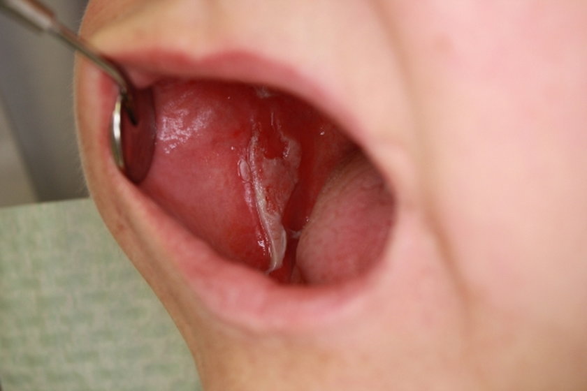 ból wewnątrz ust