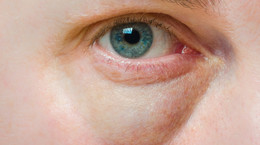 Sińce pod oczami - przyczyny, choroby, których mogą być oznaką
