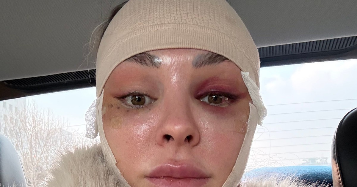 I traveled from the US to South Korea to get a facelift at 34. It ...