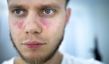 Ha ilyen az arca, nagyobb az esélye a trombózisra