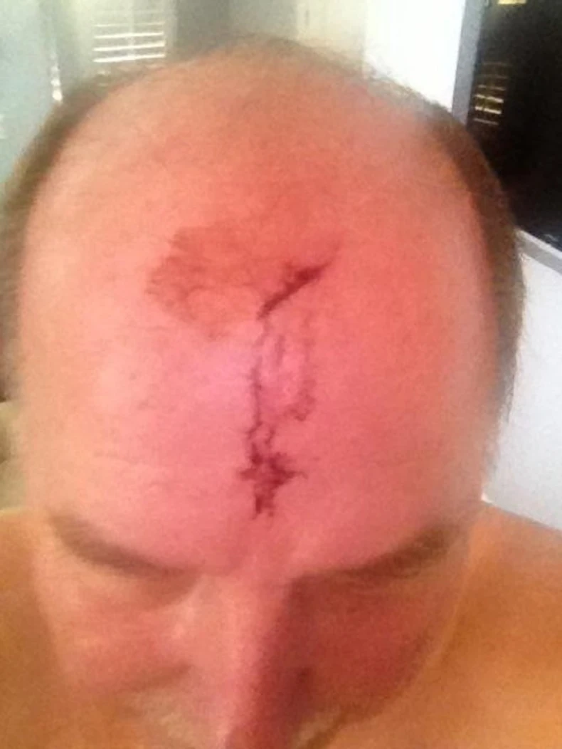 Robert Veber nakon nesreće