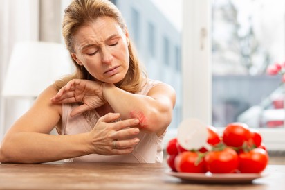 Ételallergia és allergiás kiütések: ezt üzeni a bőr az immunrendszerünkről