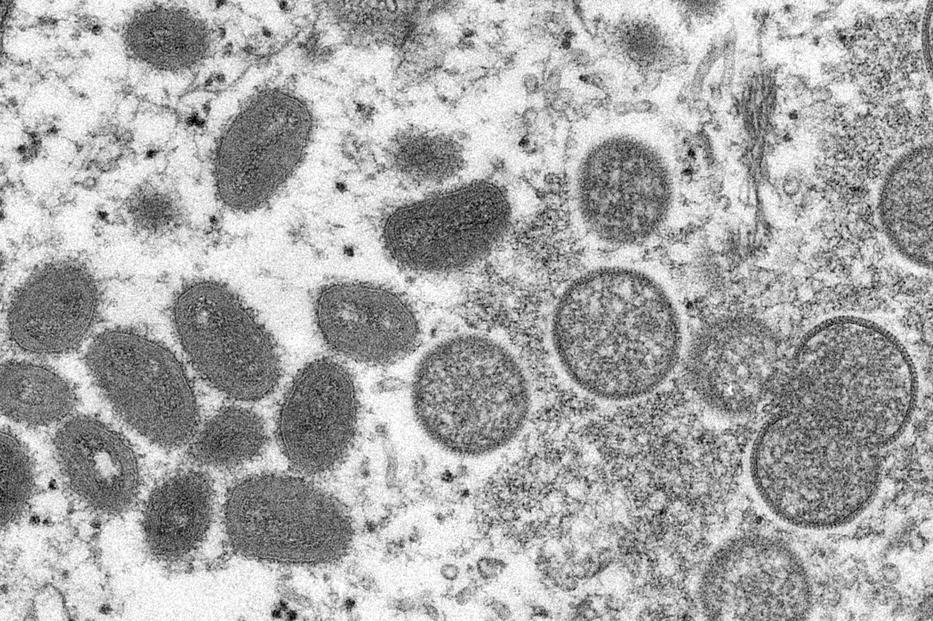 Az amerikai járványügyi és betegségmegelőzési központ, a CDC által 2022. május 19-én közreadott, 2003-ban elektronmikroszkóppal készített kép a majomhimlő virionjáról az Egyesült Államokban. A biológiai minta prérikutyából származik. 2022 májusának második felében Európa több országában vettek nyilvántartásba majomhimlővel fertőzött embereket. A hólyagos bőrkiütésekkel és lázzal járó, testnedvekkel terjedő fertőzés nyugat-afrikai eredetű, és először 1985-ben azonosították. A betegség közvetlenül terjed emlősállatról emberre, lefolyása vírustörzstől függően változik. / Fotó: MTI/AP/CDC