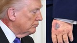 Coś się dzieje ze zdrowiem Donalda Trumpa. Nowe duże, czerwone plamy. Lekarz tłumaczy