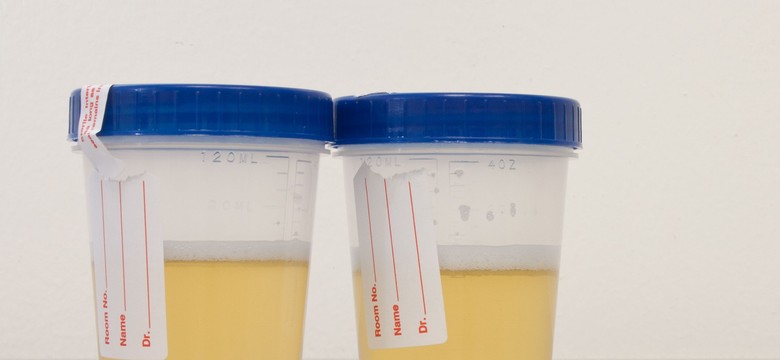 Test moczu pomoże wykryć raka prostaty i uniknąć biopsji