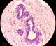Hidradenitis suppurativa mikroszkópos képe a hónalji tömegszövetekben. a tüszőhám hiperpláziája, bőrgyulladásos sejtes infiltrátum jelenlétében.