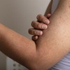 Keratoza pilaris, poznata kao "guščja koža", izaziva hrapave, crvene ili bele kvržice na koži