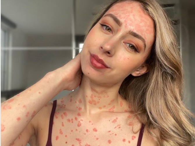 Devojka koja se bori sa psorijazom već šest godina, odlučila je da se skine i svoje telo pokaže svima