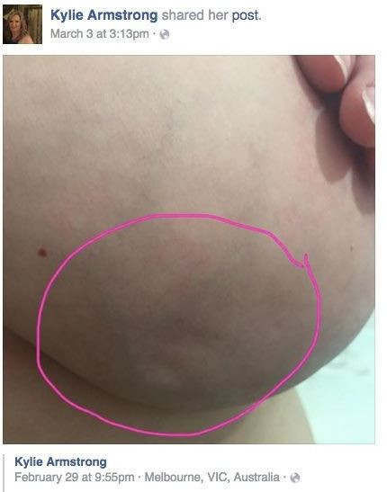 Kobieta umieściła w sieci zdjęcie piersi ze zmianami nowotworowymi