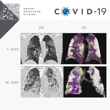 Covid-19 okozta tüdőgyulladás röntgenképe