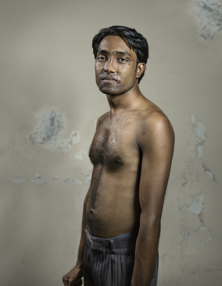 "Survivors": ofiary ataków z użyciem żrącego kwasu