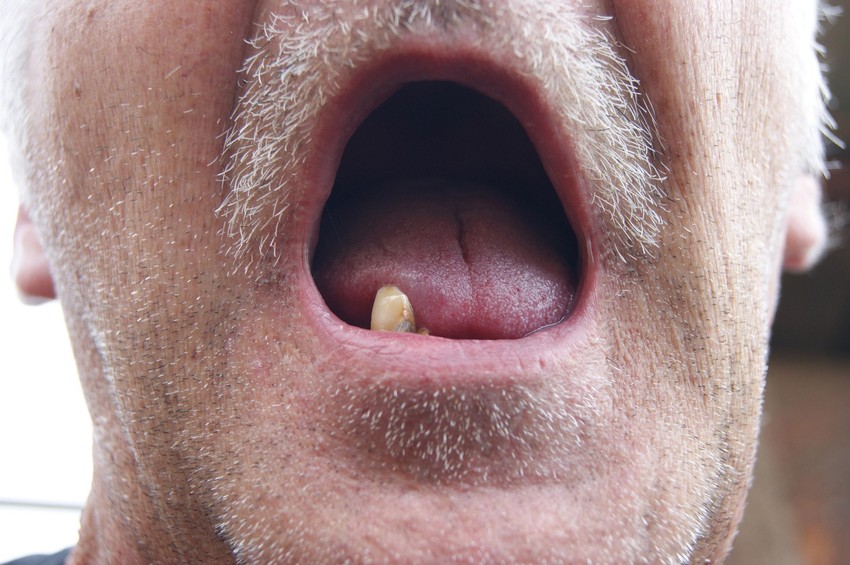 Najlakše ih izvaditi