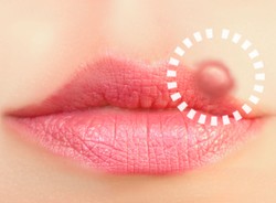 Opryszczka odbiera pamięć?