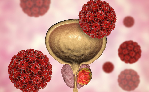 Rak prostaty staje się najczęstszym nowotworem u mężczyzn