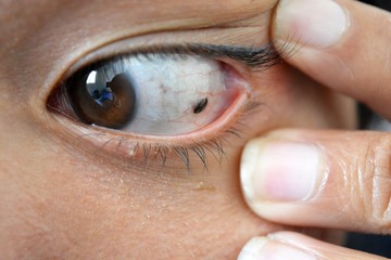 melanoma, eye