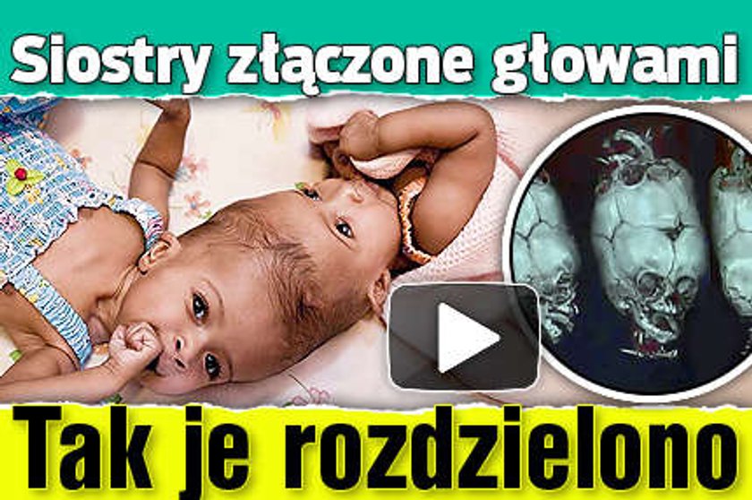 Siostry złączone głowami. Tak je rozdzielono. FILM