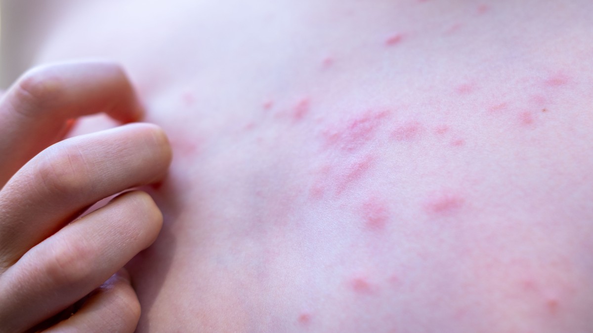 Stopala su posebno izložena ujedima ovih buba jerdolaze u direktan kontakt sa peskom, kamenjem, školjkama, insektima i morskom vodom