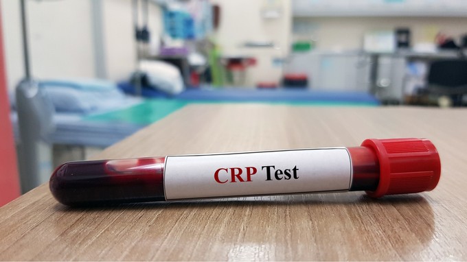 Mit jelent a CRP érték a laborleleten?