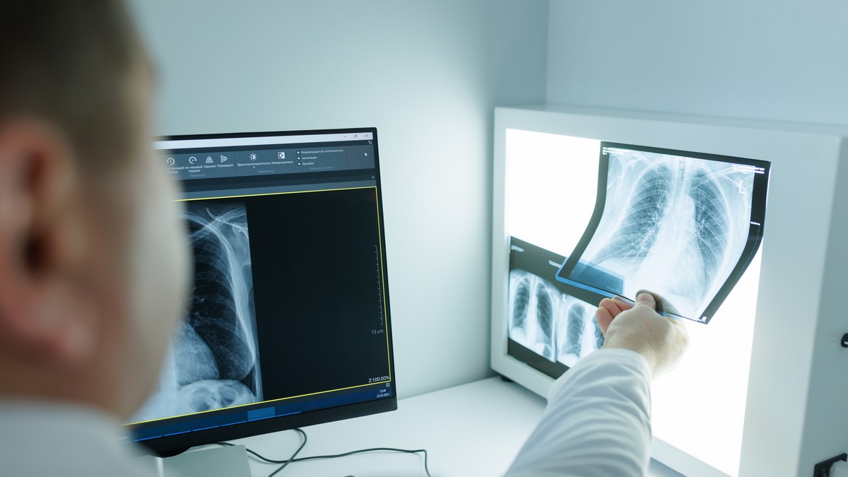 Rak pluća se otkriva brže, ali pacijenti i dalje čekaju više od mesec dana na terapiju