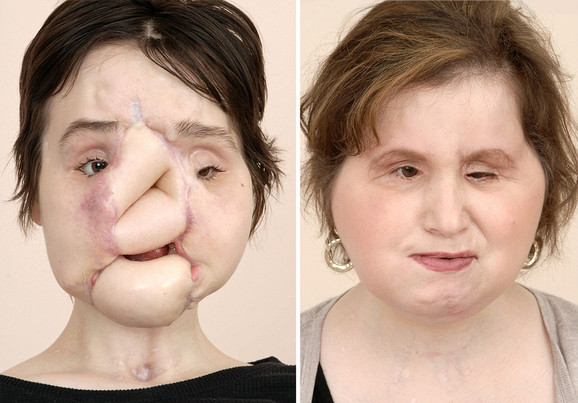 Kejti je 40. osoba na svetu kojoj je presaÄeno lice