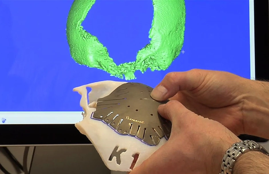 Titanijumska ploča koja će biti pričvršćena preko rupe na Malalinoj lobanji