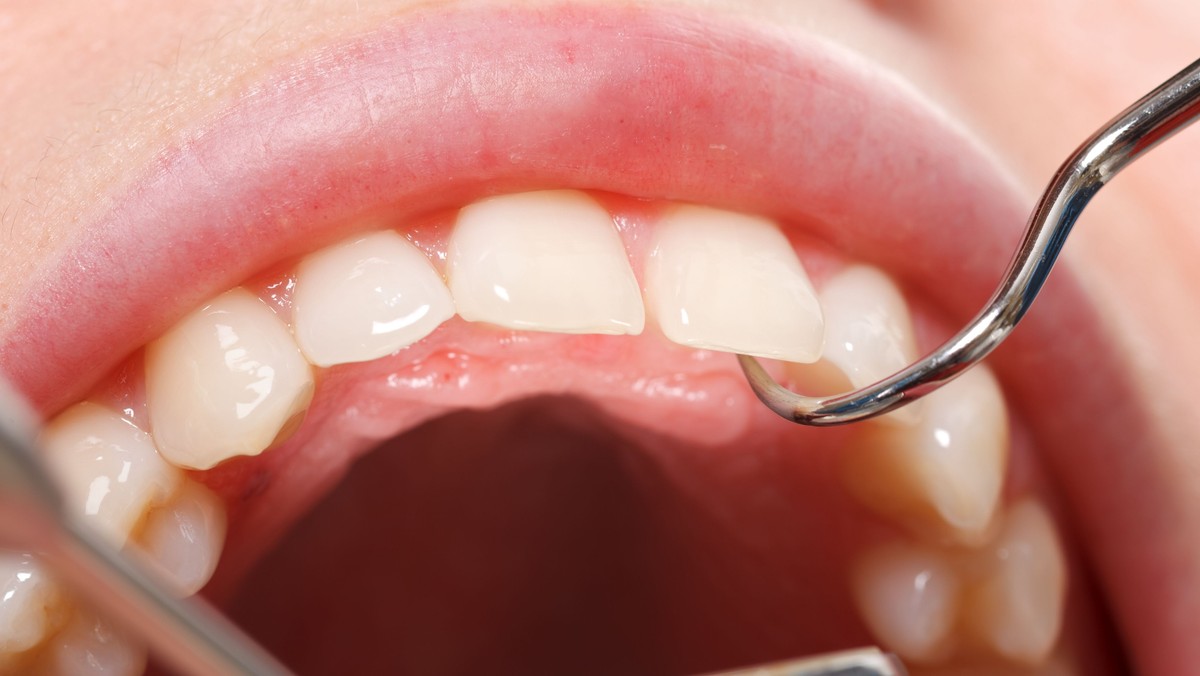 Dentysta Włożył Coś Do Dziury Po Zębie