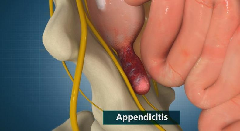 Appendicitis