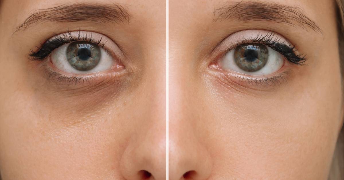 To orzeźwiające żel-serum pokona worki pod oczami! Sińce i zmarszczki znikają w trymiga!
