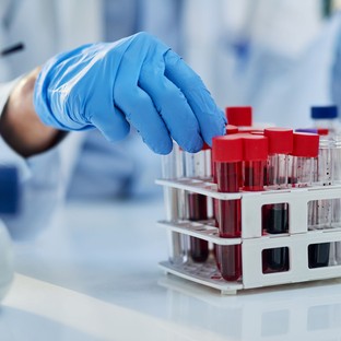 Egy új vérvizsgálat akár több mint 50 ráktípust képes lehet kimutatni - még a tünetek megjelenése előtt