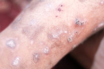 Kiterjedt vagy régóta fennálló esetben az egész testfelszínt borítják tünetek, felmaródott, 1-2 mm átmérőjű papulák (kidomborodó, apró, piros bőrelváltozások). Az atkák a zsírosabb arcbőrt kerülik.