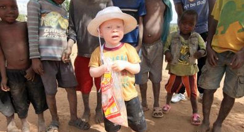 Attacks on albinos in Malawi surge, body parts sold for witchcraft