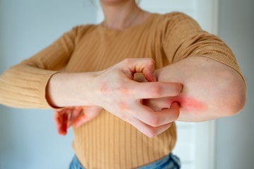 ekcéma ellen, bőrbetegség, hidratálás, viszket, vakar