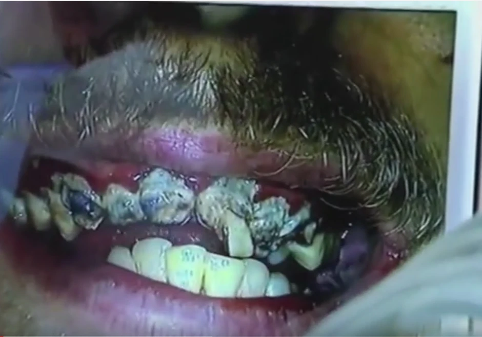 Odvratno zar ne? Sigurni smo da ne želite ovako nešto u svojim ustima