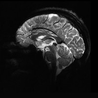 Tűpontos agyi felvétel: beüzemelték a világ legerősebb MRI gépét