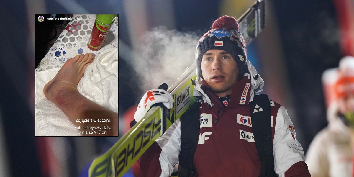 Kamil Stoch pokazał zdjęcie kontuzjowanej kostki