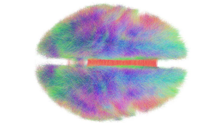 Ez nem színes szőrmekucsma, hanem az emberi agy idegi kapcsolatainak renderelése 20 alany adatai alapján. A fehérállomány-architektúráját alkotó anatómiai rostok az áthaladási irányok szerint kaptak színkódot. / Kép: Andreas Horn/NeuroImage/Wikimedia Commons