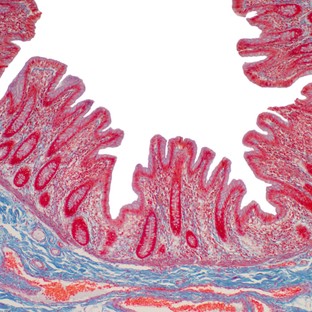 Mikroszkópos colitis: ilyen tünetekkel jár a gyulladásos bélbetegségek (IBD) harmadik típusa