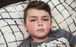 Liczba zanotowanych przypadków szkarlatyny w grudniu wzrosła ośmiokrotnie