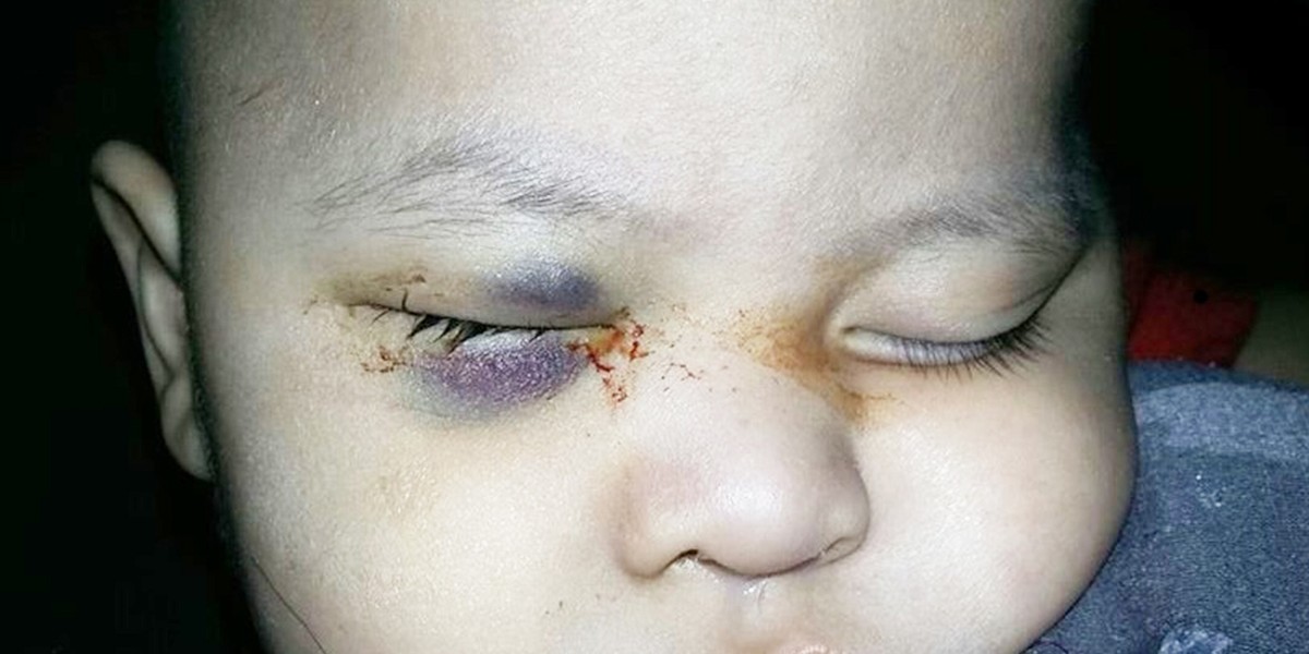 Baby Blinded When Surgeon Removes Wrong Eye