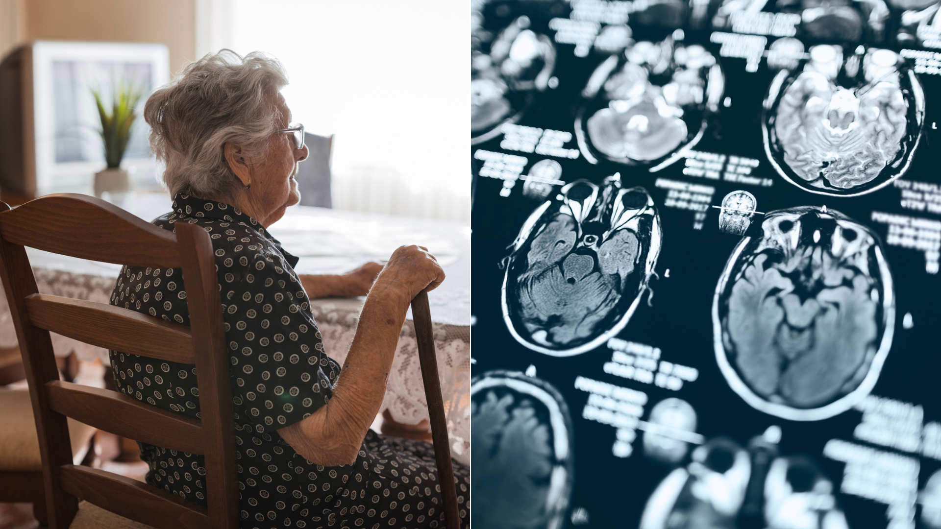 Alzheimerova choroba sa môže prenášať z človeka na človeka, zistili vedci