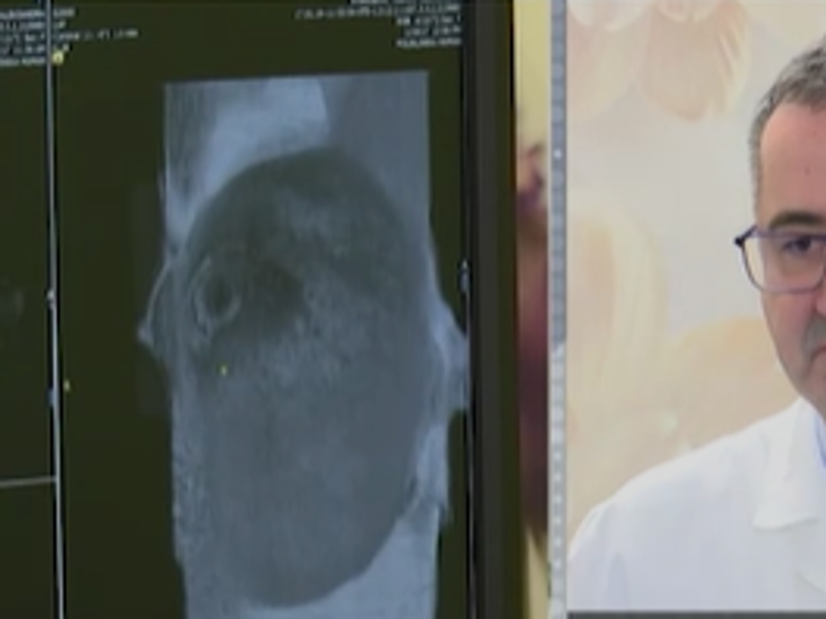 Nove terapije za rak dojke o trošku države: Dr Žegarac o važnosti ranog otkrivanja