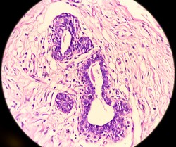 Hidradenitis suppurativa mikroszkópos képe a hónalji tömegszövetekben. a tüszőhám hiperpláziája, bőrgyulladásos sejtes infiltrátum jelenlétében.