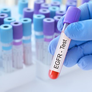 Mit jelent az eGFR érték a laborleleten?