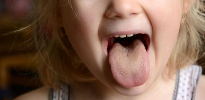 Masz żółty język? To objaw poważnej choroby